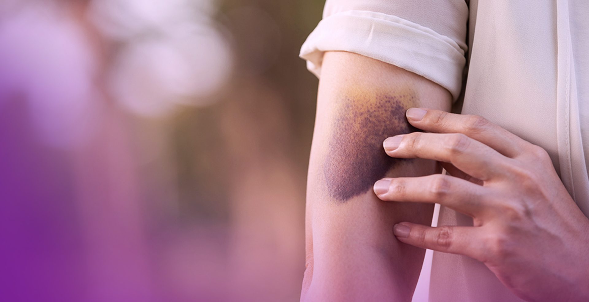 O Que Torna HirudoidⓇ O Líder Na Categoria De Hematomas