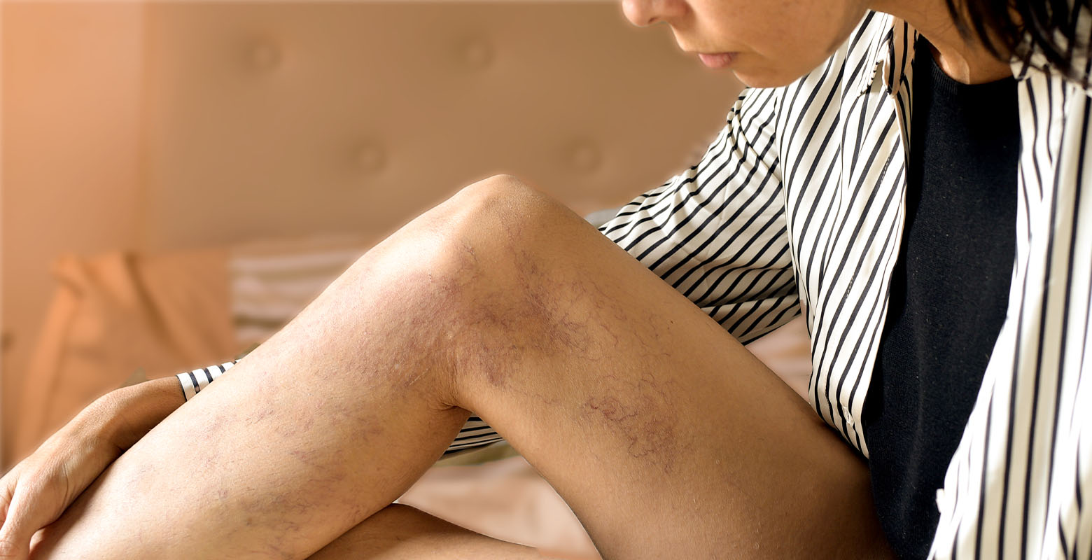 Guia Rápido Varizes: Causas, Sintomas e Opções De Tratamento 